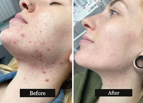 TCA peel là gì? Có tốt không? Những lưu ý an toàn