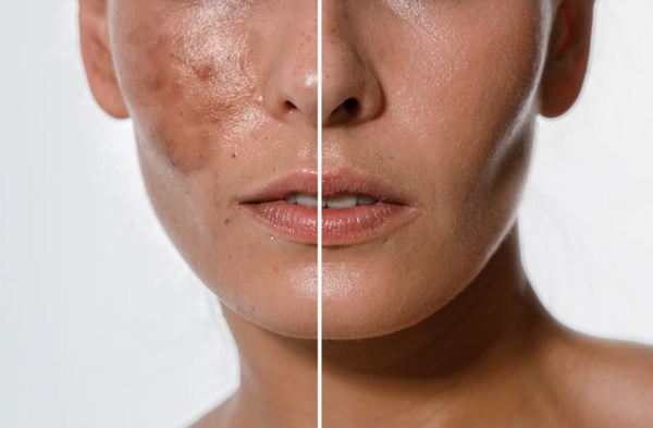 TCA peel là gì? Có tốt không? Những lưu ý an toàn