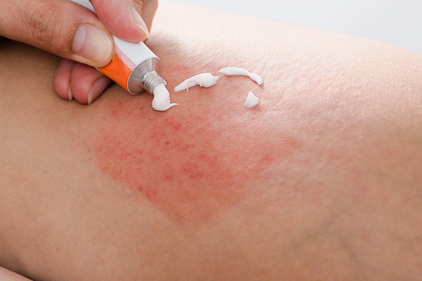 Triệt lông laser bị ngứa: bình thường hay bất thường?