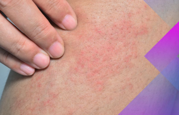 Triệt lông laser bị ngứa: bình thường hay bất thường?