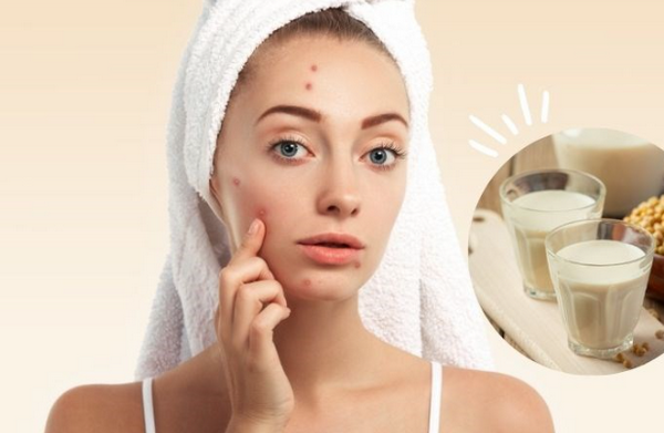 Uống sữa có nổi mụn không? Cơ chế và cách kiểm soát