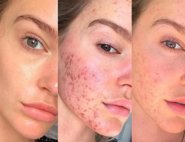 Uống trà sữa có nổi mụn không? Sự thật khiến nhiều người bất ngờ