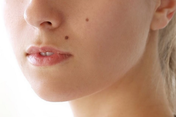5 Cách Tẩy Nốt Ruồi Tại Nhà Và Lời Khuyên Từ Chuyên Gia Da Liễu 
