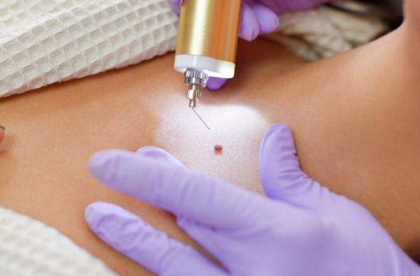 5 Cách Tẩy Nốt Ruồi Tại Nhà Và Lời Khuyên Từ Chuyên Gia Da Liễu