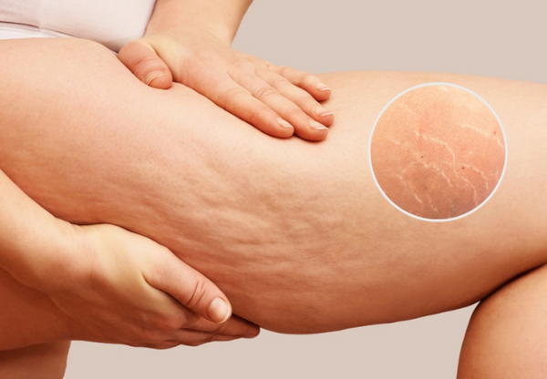 Các vị trí dễ bị rạn da nhất trên cơ thể