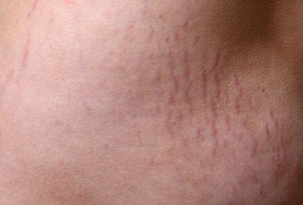 Các vị trí dễ bị rạn da nhất trên cơ thể