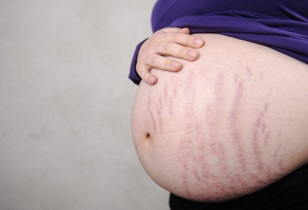 Các vị trí dễ bị rạn da nhất trên cơ thể