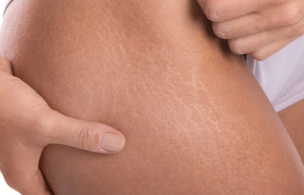 Các vị trí dễ bị rạn da nhất trên cơ thể