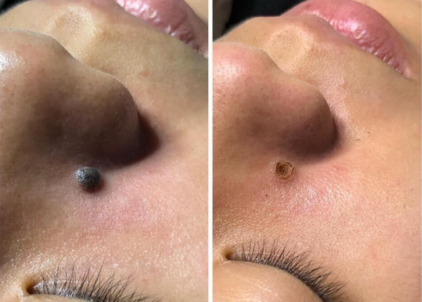 Đốt mụn ruồi có sạch không? Phương pháp xóa nốt ruồi an toàn