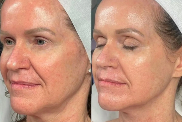 Laser Fotona 4D là gì? Công dụng và ứng dụng trẻ hóa da toàn diện