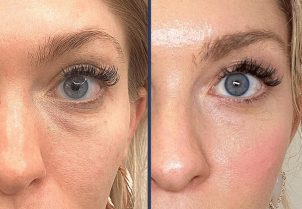 Laser Fotona 4D là gì? Công dụng và ứng dụng trẻ hóa da toàn diện