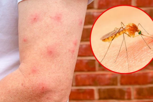 Muỗi đốt gây thâm da do đâu? 4 nguyên nhân phổ biến