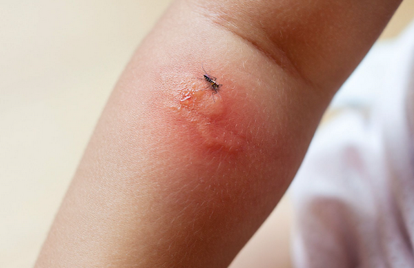 Muỗi đốt gây thâm da do đâu? 4 nguyên nhân phổ biến