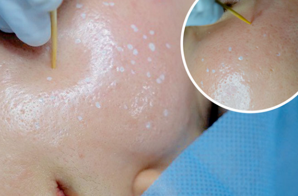 Nên dùng gì sau khi chấm TCA? Routine phục hồi da không bị thâm 