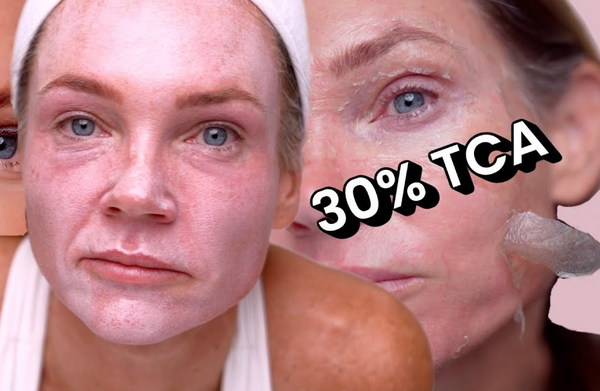 Peel TCA 30% là gì?