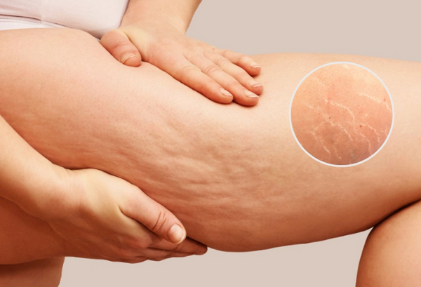 7 sai lầm khiến rạn da ngày càng nặng hơn (90% mắc phải)