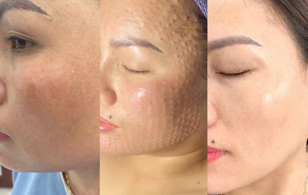 Bật mí sau tiêm meso bao lâu thì được dưỡng da