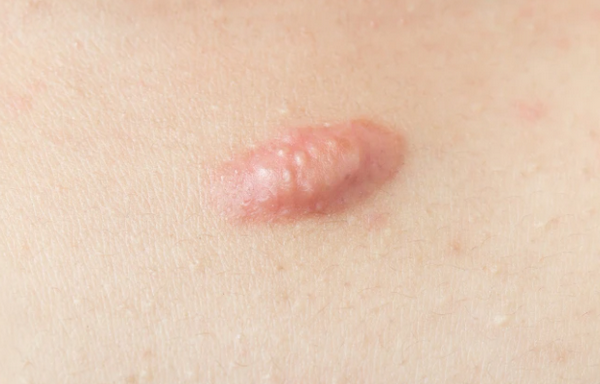 Sẹo bị ngứa là gì? Nguyên nhân & cách giảm ngứa hiệu quả