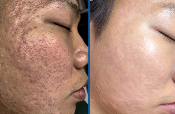 Sẹo không đầy sau bóc tách: Nguyên nhân và cách cải thiện 