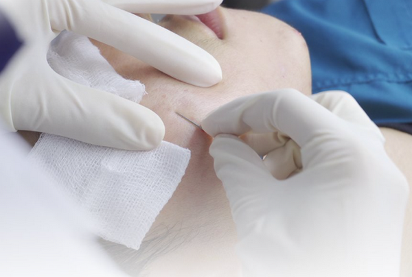 Sẹo không đầy sau bóc tách: Nguyên nhân và cách cải thiện 