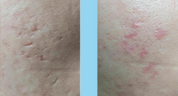 Sẹo không đầy sau bóc tách: Nguyên nhân và cách cải thiện 