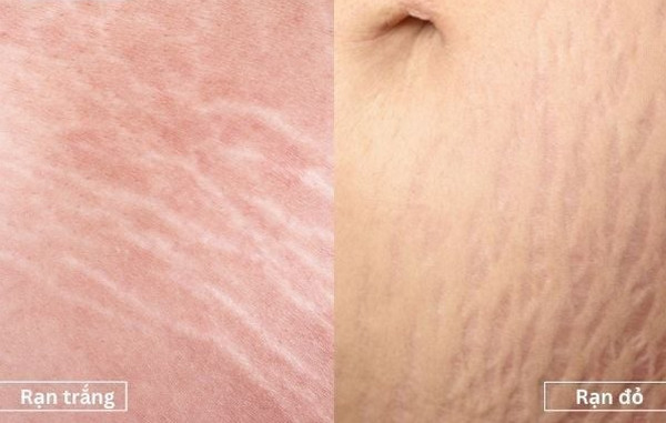 Sẹo rạn là gì? Phân biệt chi tiết và hướng điều trị hiệu quả