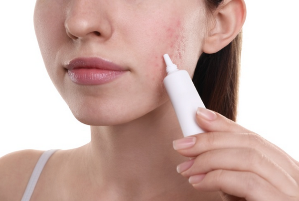 Sẹo rỗ nhẹ có tự hết không? Cách điều trị hiệu quả