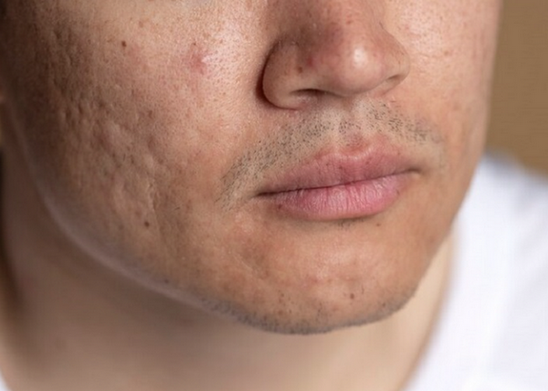 Sẹo rỗ nhẹ có tự hết không? Cách điều trị hiệu quả