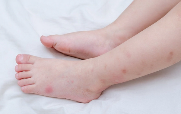 Sẹo thâm do muỗi đốt có tự hết không? Cách làm mờ nhanh tại nhà