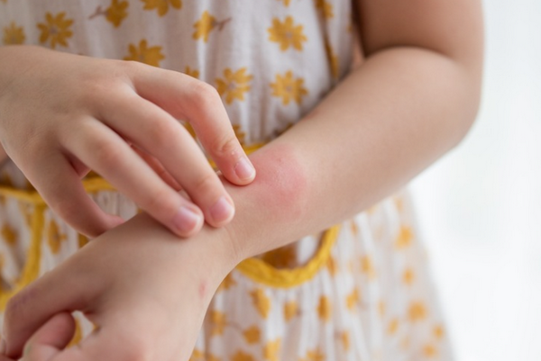 Sẹo thâm do muỗi đốt có tự hết không? Cách làm mờ nhanh tại nhà