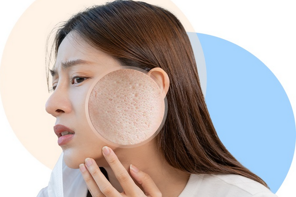 Sẹo xơ dính da là gì? Dấu hiệu nhận biết và cách điều trị hiệu quả 