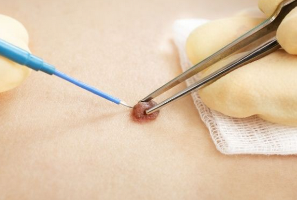 Tẩy nốt ruồi kiêng nước bao lâu? Giải đáp chi tiết