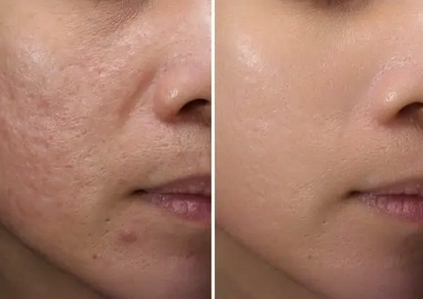 10+ cách trị da mặt sần sùi tại nhà đơn giản và hiệu quả