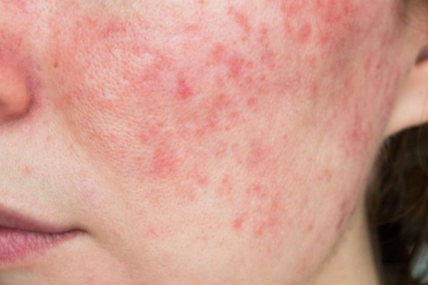 10+ cách trị da mặt sần sùi tại nhà đơn giản và hiệu quả