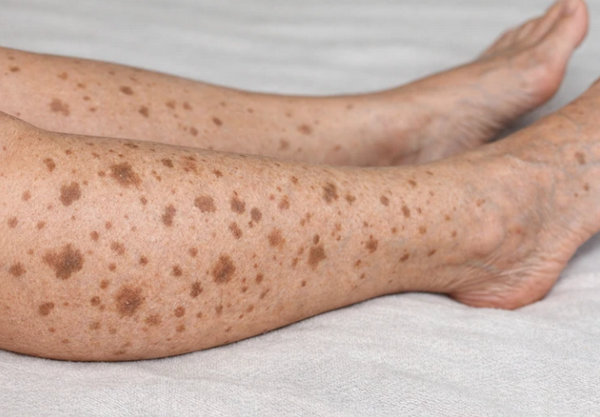 Chân Nổi Đốm Nâu Không Ngứa Là Bệnh Gì? 7 Nguyên Nhân Thường Gặp 