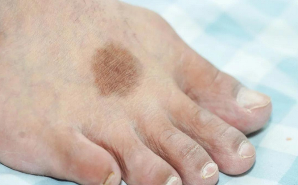 Chân Nổi Đốm Nâu Không Ngứa Là Bệnh Gì? 7 Nguyên Nhân Thường Gặp