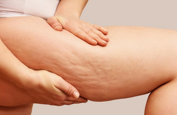 Da Sần Vỏ Cam Là Gì? Nguyên Nhân Và Cách Cải Thiện Hiệu Quả