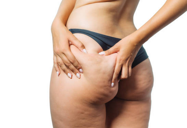 Da Sần Vỏ Cam Là Gì? Nguyên Nhân Và Cách Cải Thiện Hiệu Quả