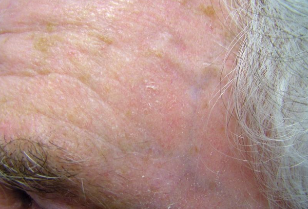 Dày Sừng Ánh Sáng Là Gì? Nguyên Nhân, Dấu Hiệu Và Cách Điều Trị