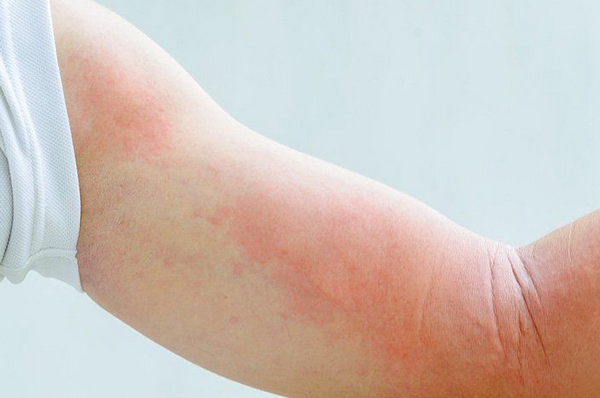 Dị Ứng Ánh Nắng: Nguyên Nhân, Dấu Hiệu Và Cách Điều Trị Hiệu Quả