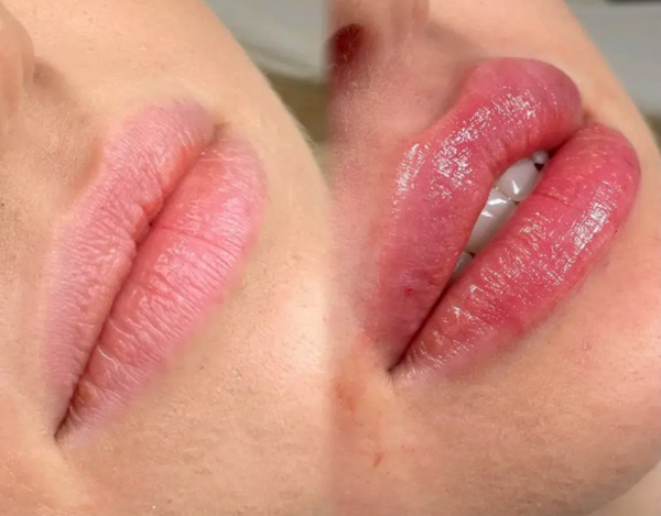 Filler Revolax: Công dụng, thành phần và so sánh với loại filler khác