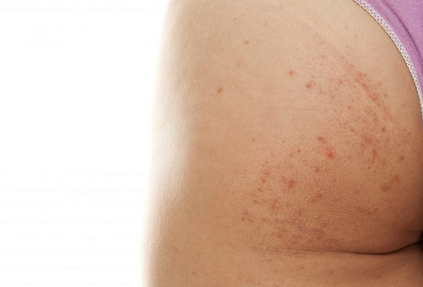 Kem Trị Thâm Mông: Cách Chọn Sản Phẩm Hiệu Quả Và An Toàn