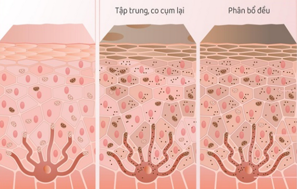 7 Sai Lầm Khi Dùng Kem Trị Thâm Nhũ Hoa Khiến Hiệu Quả Kém Đi