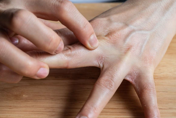 Nấm kẽ chân tay: Dấu hiệu nhận biết, nguyên nhân và cách điều trị