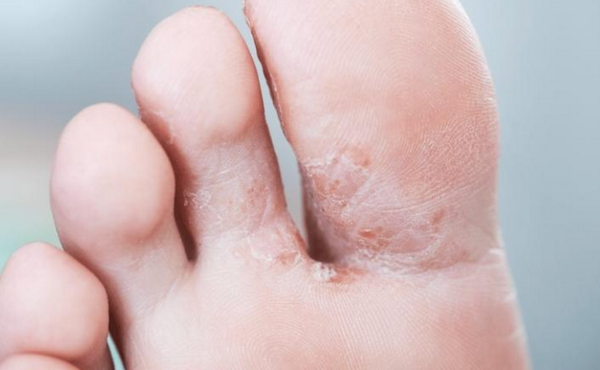 Nấm kẽ chân tay: Dấu hiệu nhận biết, nguyên nhân và cách điều trị