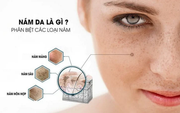 Nám Thượng Bì Là Gì? Dấu Hiệu, Nguyên Nhân Và Cách Điều Trị Hiệu Quả