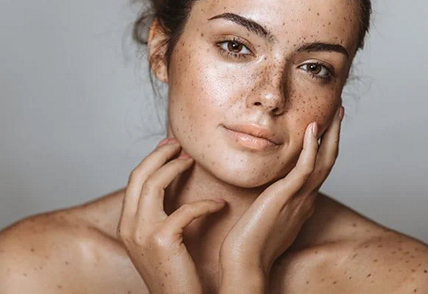 Nám trung bì là gì? Nguyên nhân, dấu hiệu và cách điều trị