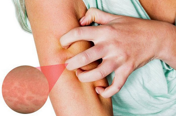 Ngứa Da Mùa Hè: Nguyên Nhân, Cách Điều Trị Và Phòng Ngừa Hiệu Quả