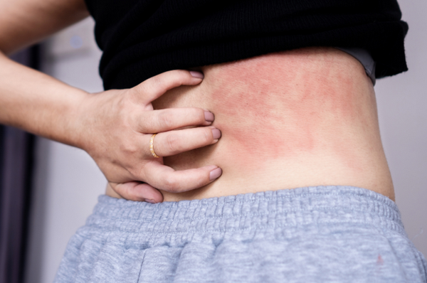 Ngứa Da Mùa Hè: Nguyên Nhân, Cách Điều Trị Và Phòng Ngừa Hiệu Quả