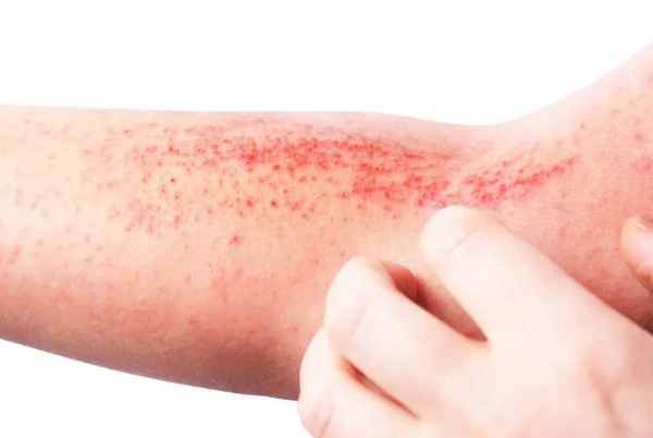 Nổi Mẩn Đỏ Ở Chân Tay Là Bệnh Gì? 10 Nguyên Nhân Thường Gặp
